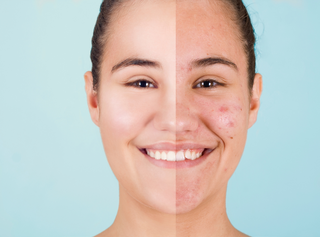 Can Collagen Cause Acne? Separating Fact from Fiction