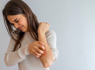 Collagen and the Treatment of Eczema: A Deep Dive into Skin Health